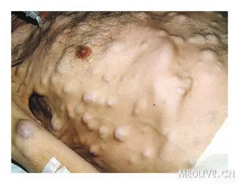 上图:病史:70岁老年男性因消瘦和咯血而就诊.