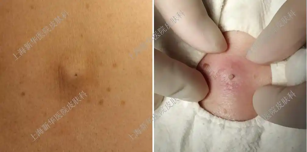 没错,这就是传说中的皮脂腺囊肿!