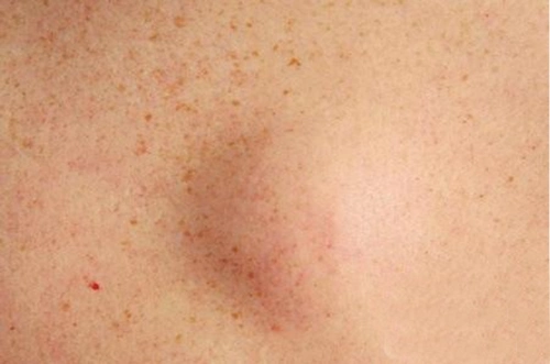 根据图片教你如何分清脂肪瘤类型