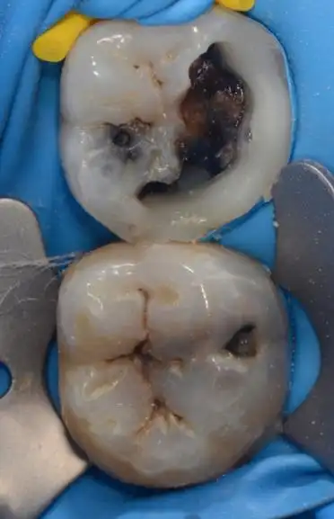 然后开始去腐,我习惯用金刚砂球钻先从边缘去腐,最后开髓,最好不要用