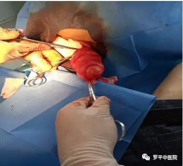 脂肪瘤对人体危害不大,但治疗方式只有手术切除.大家要注意饮