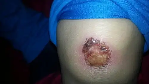 膝盖摔了一下,好像有点脓,不知道要不要去医院看看?