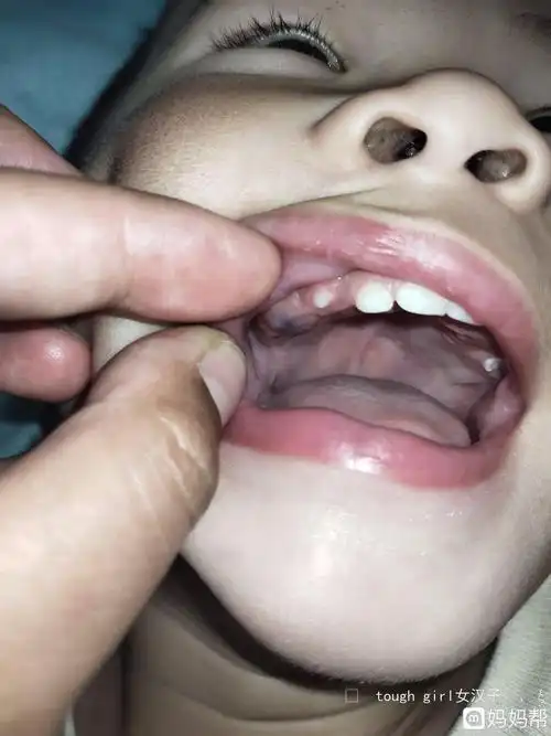 宝宝大牙牙龈发紫是怎么回事 是长牙齿憋的