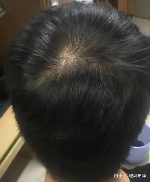 发旋这样稀疏是脱发了吗还有救吗