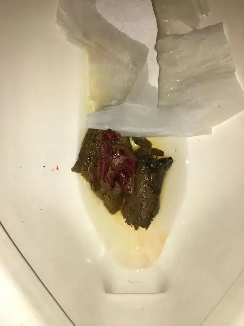 拉出来肛门口非常痛 裂痛的 (本身有痔疮)我想问我这是胃出血