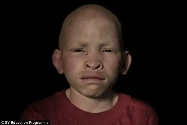 外媒揭露非洲白化病人肢体贩卖链