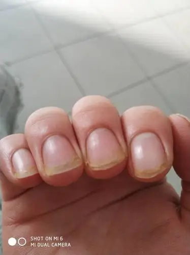 谁能跟我说说手指甲脱层是怎么回事