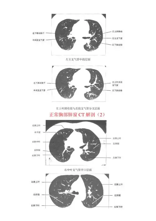 正常胸部ct肺窗和纵隔窗