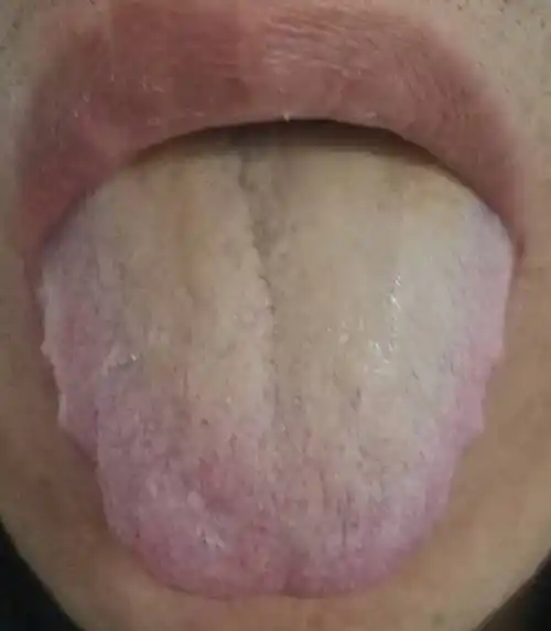 可怕的肾虚,从舌头就能看出来