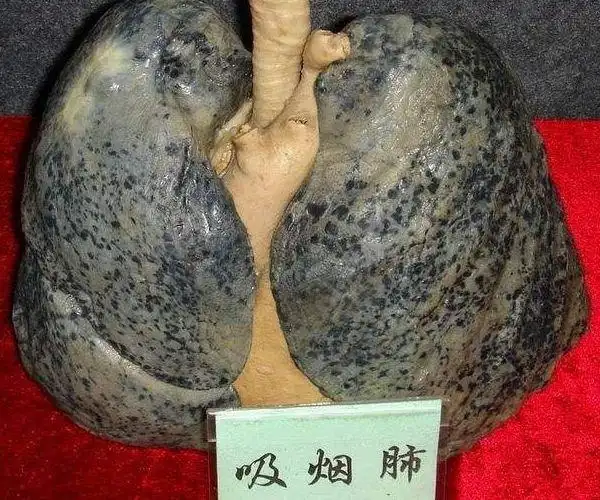 长期吸烟的人,肺怎样了?若没3种表现,或许它还"顶得住"