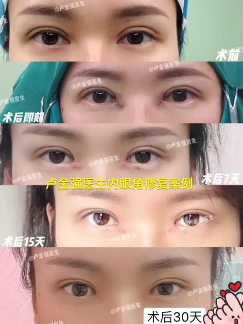 虽然照片拍的有点向下了,但是内眼角还是可以看到恢复的不错,形态很好