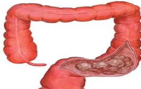 直肠癌的早期症状_直肠癌是怎么引起的_直肠癌治疗方法