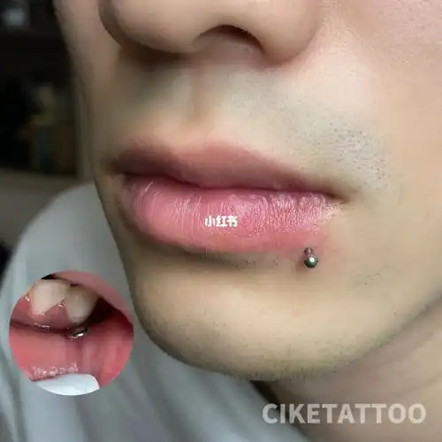 侧唇钉穿刺12mm平底杆 3mm基础圆球徒手穿刺 位置准确 底座贴合所用钛