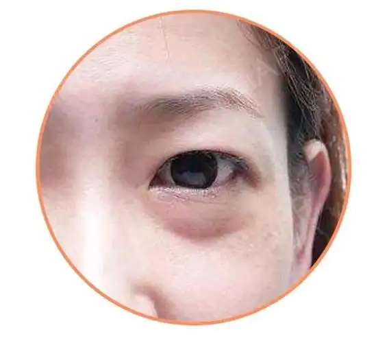 【郑州美眼整形】眼袋还分类型?教你判断自己属于哪一种!