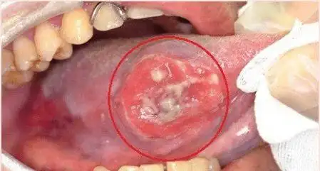 嚼槟榔嚼出口腔癌哈医大四院口腔颌面外科专家口腔癌及早治疗存活率高