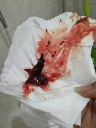 怀孕初期出血像月经一样鲜红