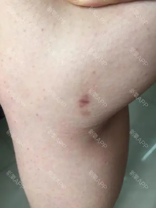 新氧- 糊涂大王 | 美体塑形 | 大腿吸脂 | 吸脂瘦手臂 | 吸脂瘦大腿