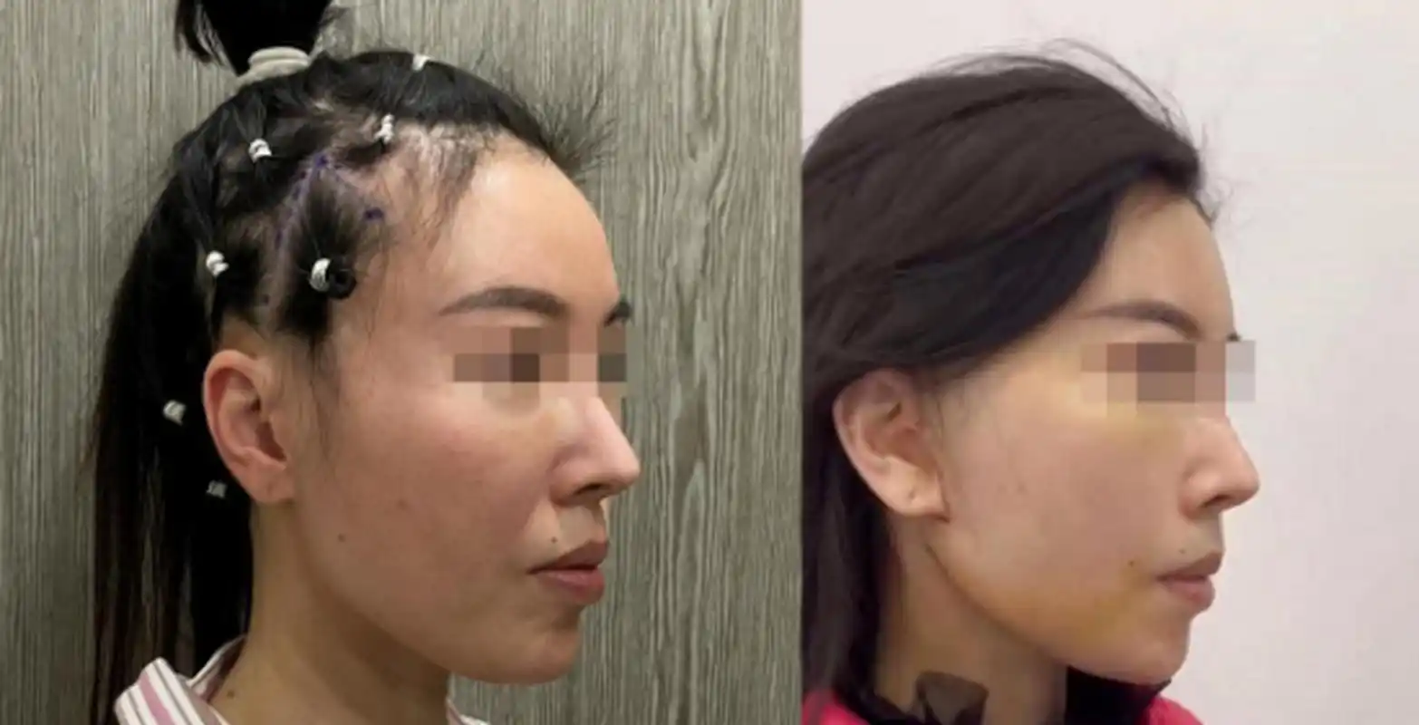 给大家看个案例,#拉皮手术# 前后对比,你们觉得变化大吗?#拉皮