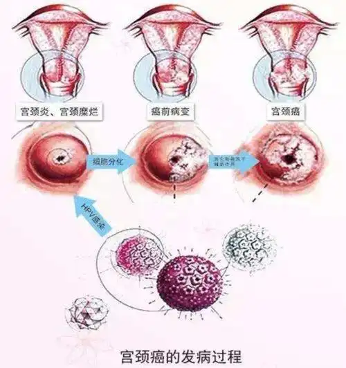 写美篇                       hpv如何引发宫颈癌