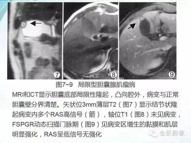 来学学胆囊腺肌症影像表现及鉴别