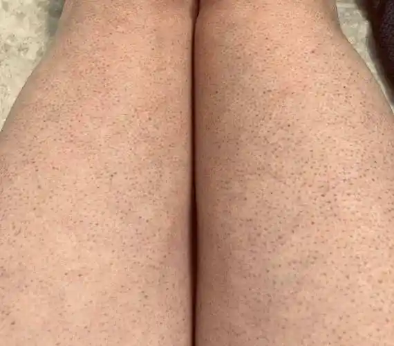 毛周角化症,内分-泌 丢弃   平衡  一调配欠妥  脂肪类摄入  肉和激素