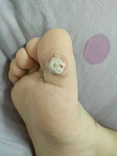 脚鸡眼图片 (1)_有来医生