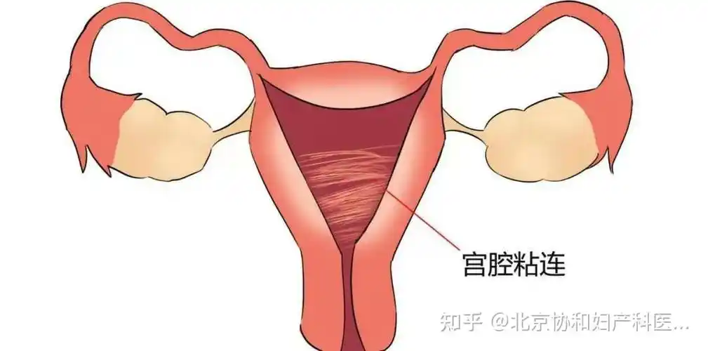 女性朋友怎么去判断自己是否有宫腔粘连 - 知乎