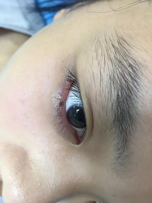 睑缘痣激光治疗前后图片 - 好大夫在线