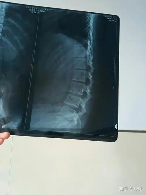 先天腰间盘突出,脊柱达到45度弯曲的人有多痛苦?