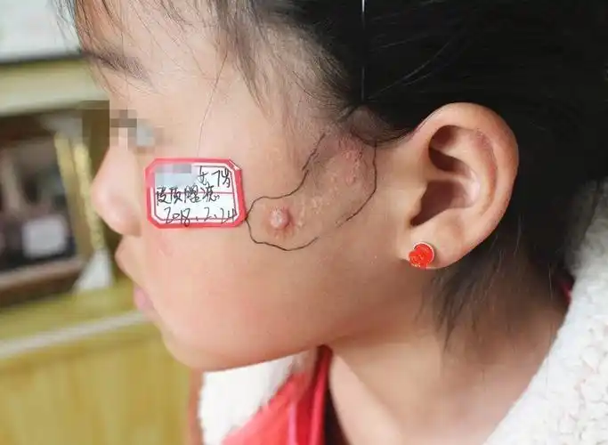 问:皮脂腺痣长什么样?