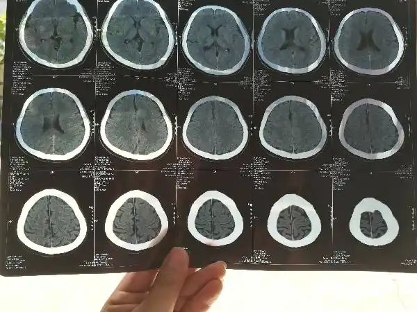 请问哪位一生可以帮我看看这张脑ct片子有什么问题?