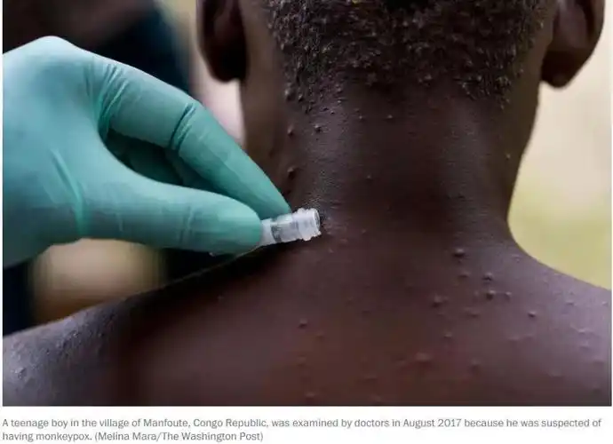 类似天花,时隔近20年美国再现这一病毒_腾讯新闻