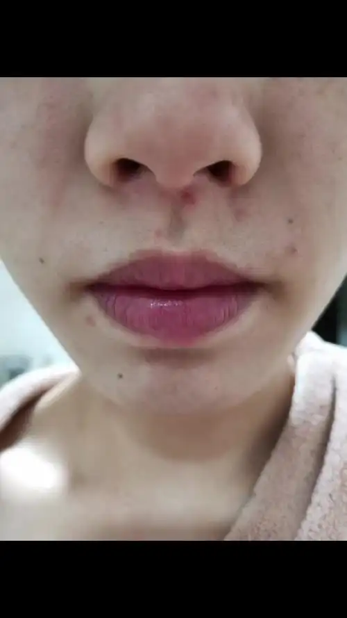 嘴巴周围一直长这种红色小痘痘,很痛,怎么办啊,是什么原因引起的,一直