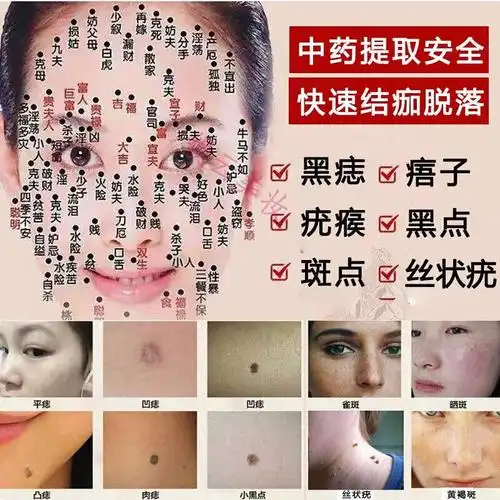 药水点痣水药水无痕脸部黑点痦子丝状疣瘊子去肉痣膏修复