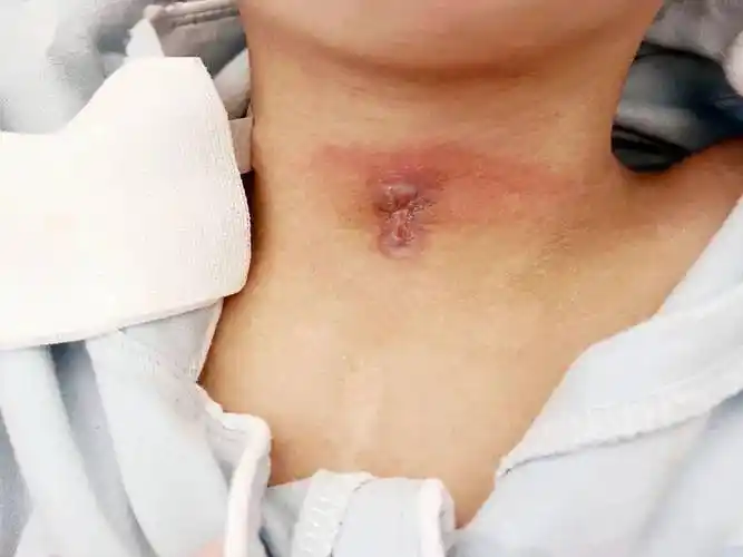 成功堵管后第三天,切口愈合良好患者董某,女,今年65岁,因"右侧肢体