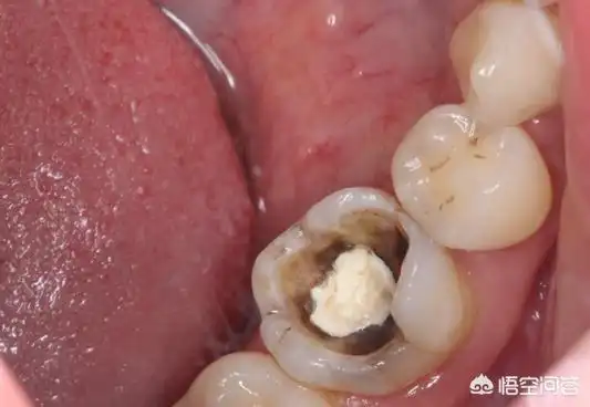 一次性补牙四颗用了1500贵吗?半个小时就搞定了?_网易订阅