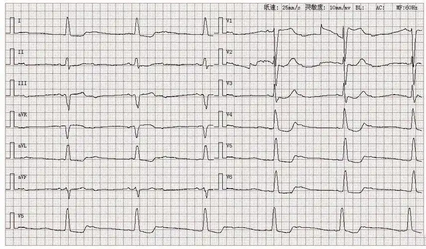 心电图图库丨二度ii型(2:1)房室传导阻滞系列