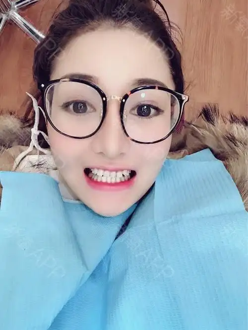 上海隐形托槽矫正好不好_效果图_氧气x0qlx隐形托槽矫正术后第27天