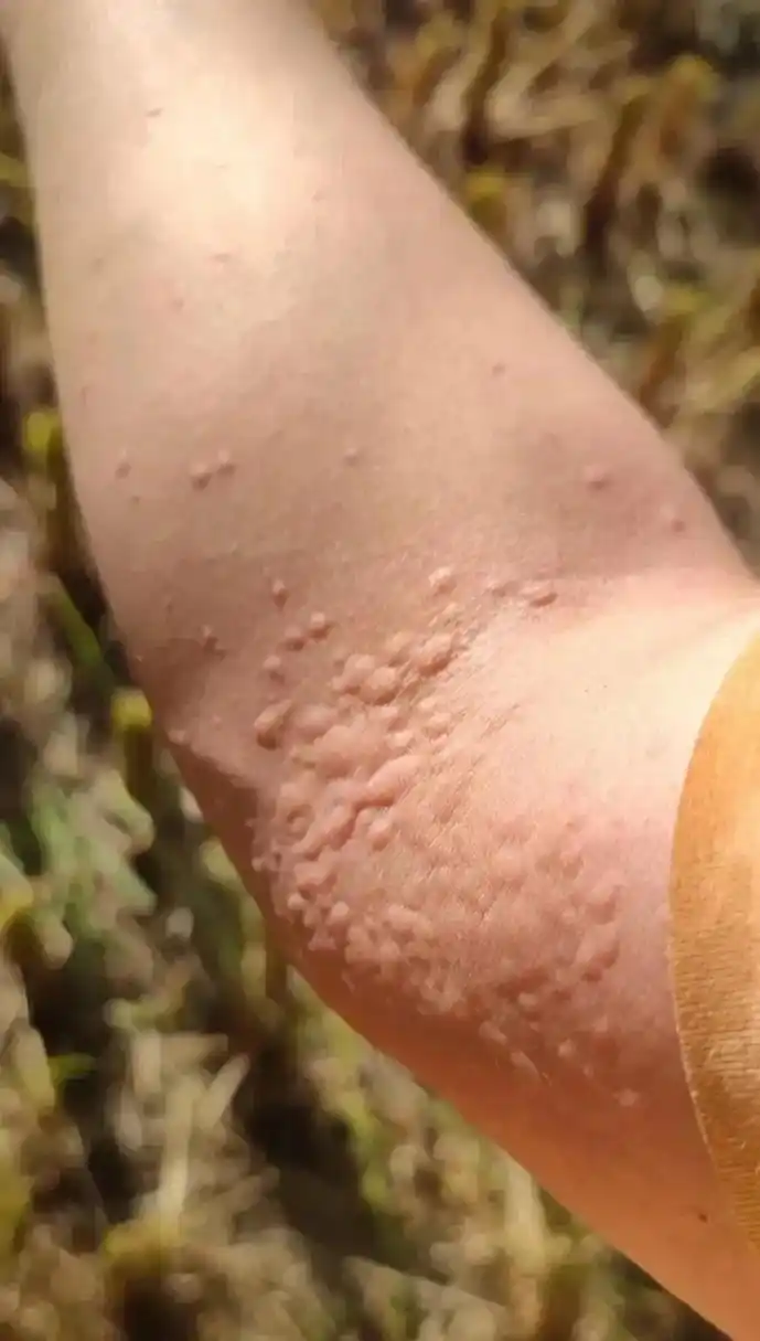 睡了一会起来胳膊被蚊子咬成这样了啊.气死了啊咋办呀