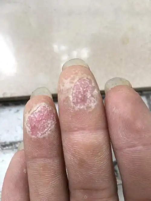 手指连续三层脱皮,只是中指和无名指脱皮,怎么回事?