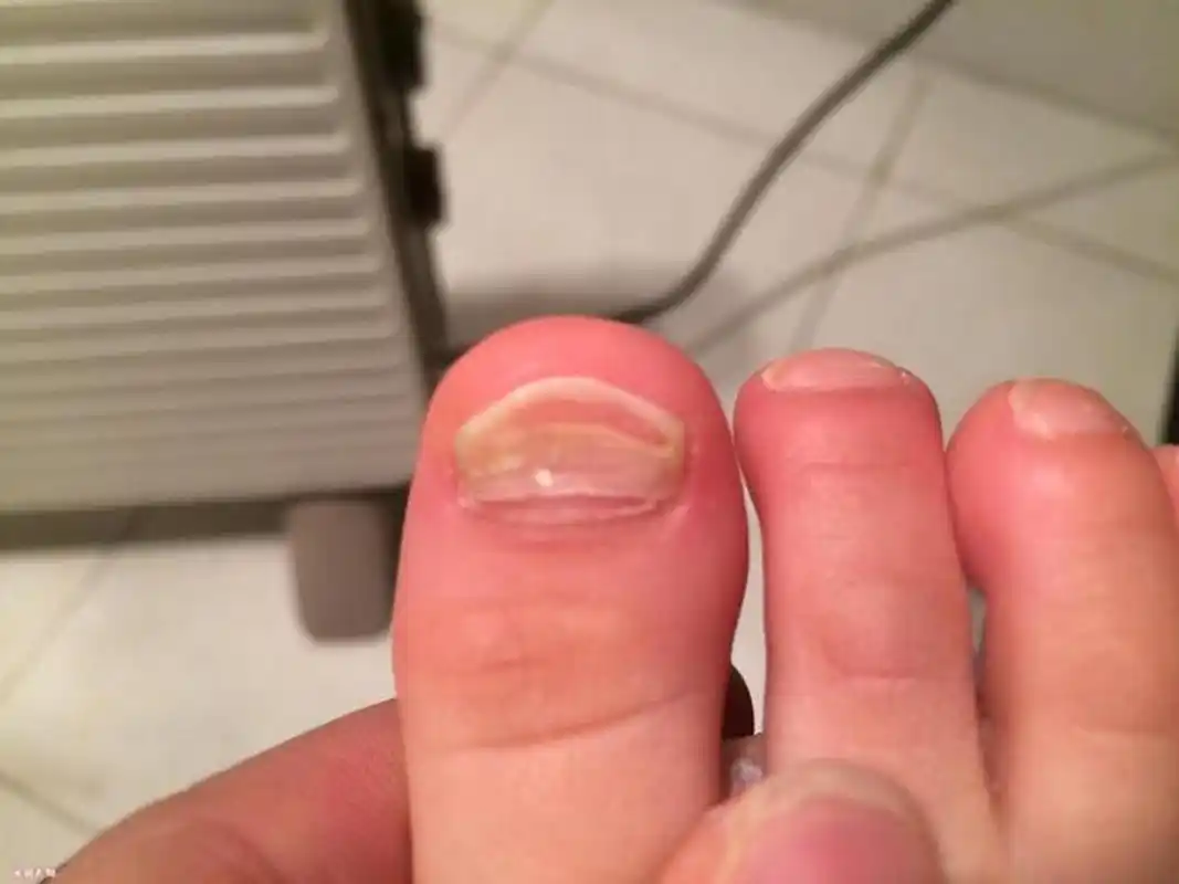 一般情况下,宝宝的脚趾甲出现分层断裂现象,可能是因为宝宝挑食营养