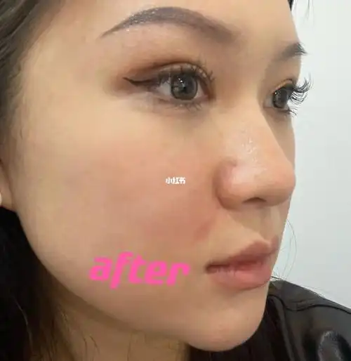 玻尿酸鼻基底填充