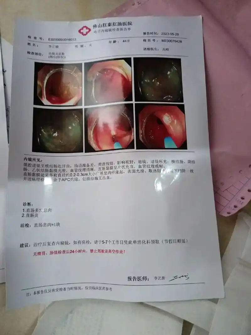 胃体黏膜粗大星脑回状,黏膜充血,肖底,胃体可见直径约0.3- - 抖音