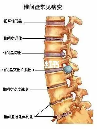 腰间盘676005 什么是腰盘间69膨出,突出,脱出?