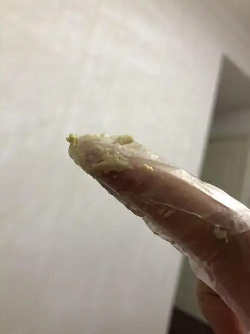 支原体感染,霉菌性阴道炎,白带总是这种样子,奇痒无比,好.