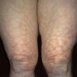 网状青斑和青斑性血管炎