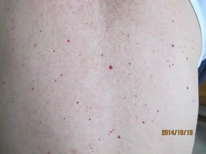 带您了解老年性血管瘤(身上的小红点)