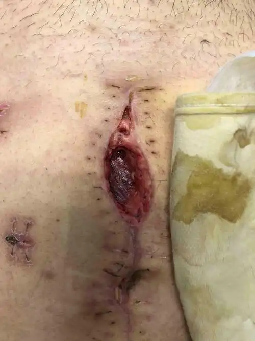 伤口裂开再缝合的,伤口已长好,缝合和换药都很重要