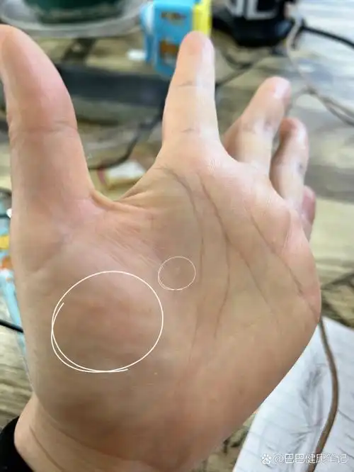 手上长一个个透明的凸起的,手心里长,以前是一只手