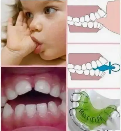 贝克汉姆女儿被牙齿毁掉颜值,这锅到底谁来背!_奶嘴